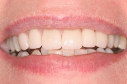 Healthy attractive smile after dental restoration