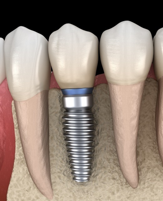 Animated dental implant supported dental crown