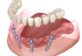 Illustration of implant denture