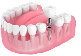 diagram showing dental implant, abutment, and restoration