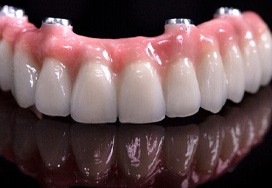 closeup of implant dentures