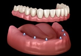Animated all on four dental implant supported denture placement