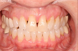 Smile with severe gum tissue recession before periodontal therapy