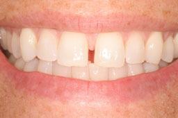 Smile with gap between top teeth before clear braces