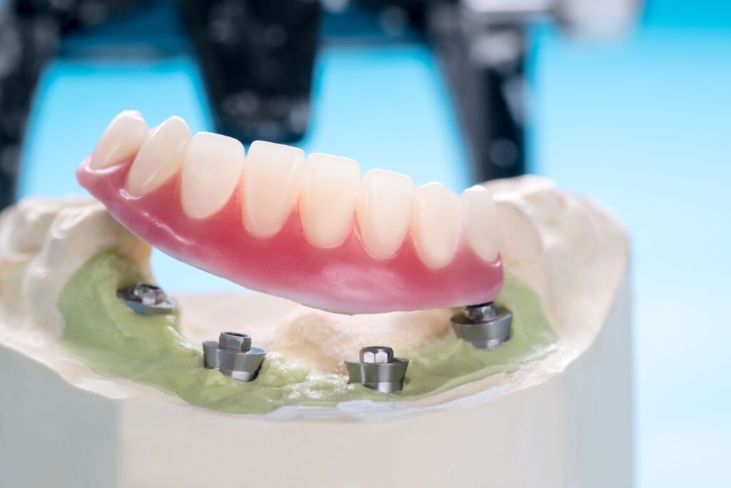 Full set of lower dentures on model jaw with four sample implants