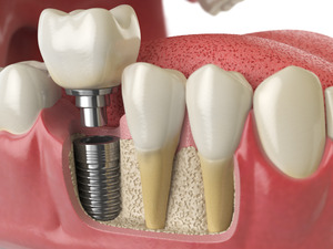 What Makes Dental Implants Work So Well? | Dooley Dental