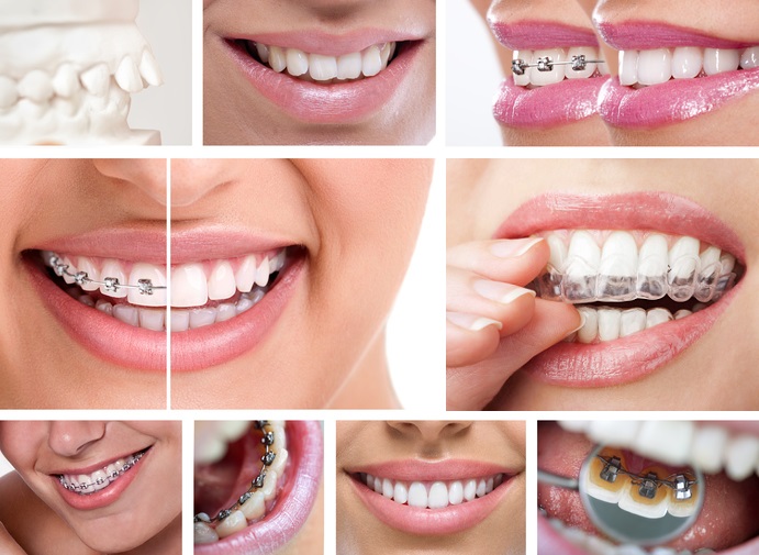 Delta dental teeth whitening cost